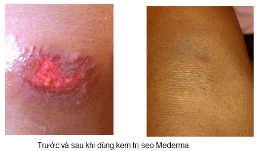 Hiệu quả khi dùng Kem trị sẹo Mederma Hiệu quả khi dùng Kem trị sẹo Mederma