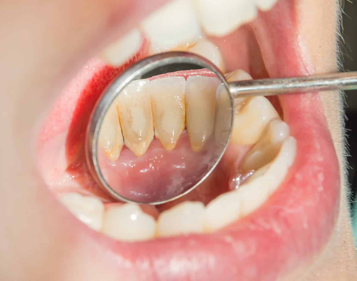 hướng dẫn về dinh răng miệng tại nhà